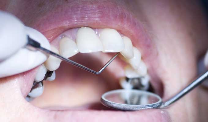 وزارة الصحّة تمنع استعمال ملغم الأسنان في علاج الأسنان، عند الأطفال دون سن الخامسة عشرة والنساء الحوامل والمرضعات - سوفاس نيوز